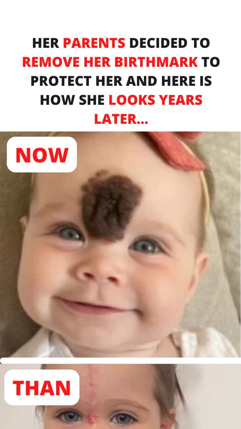 Her Parents Decided to Remove Her Birthmark to Protect Her and Here is ...